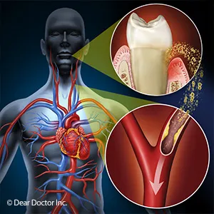 Illustration showing the link between heart disease and oral health