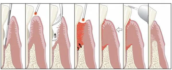 Diagram illustrating the LANAP process to removed diseased gum tissue