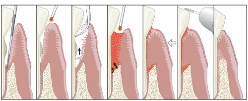 Diagram illustrating the LANAP process to removed diseased gum tissue